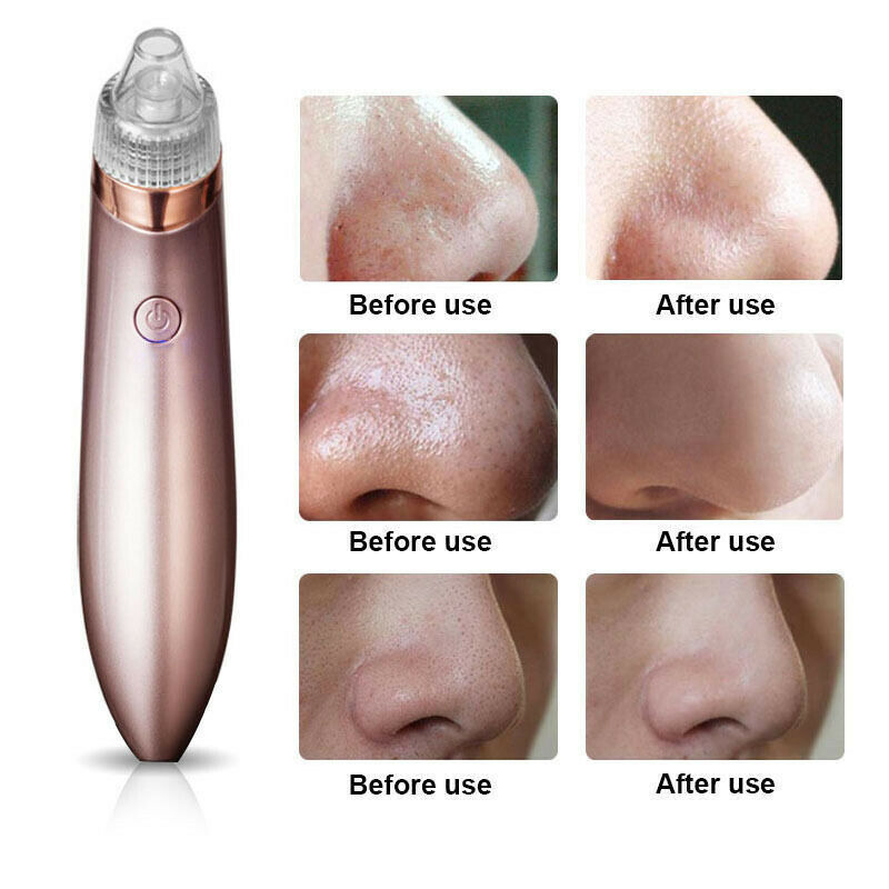 Electric Blackhead Vacuum Pore Cleaner Acne Pimple Remover Strong Suct